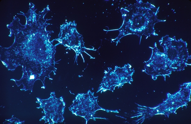 В Швеции нашли средство борьбы с раковыми клетками