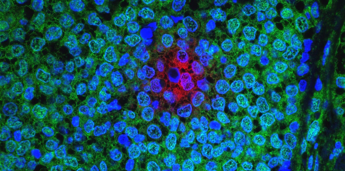 Интеллектуальные наночастицы помогут бороться с раком