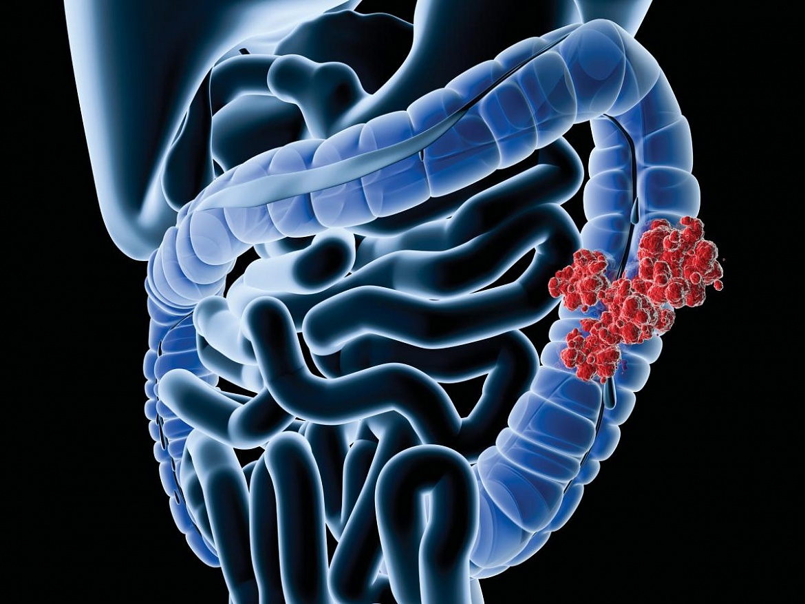 Исследование колоректального рака