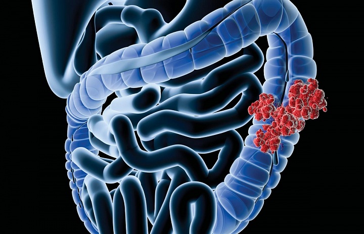 Исследование колоректального рака