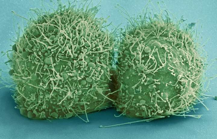 Ученые рассказали о странном состоянии клеток при развитии рака