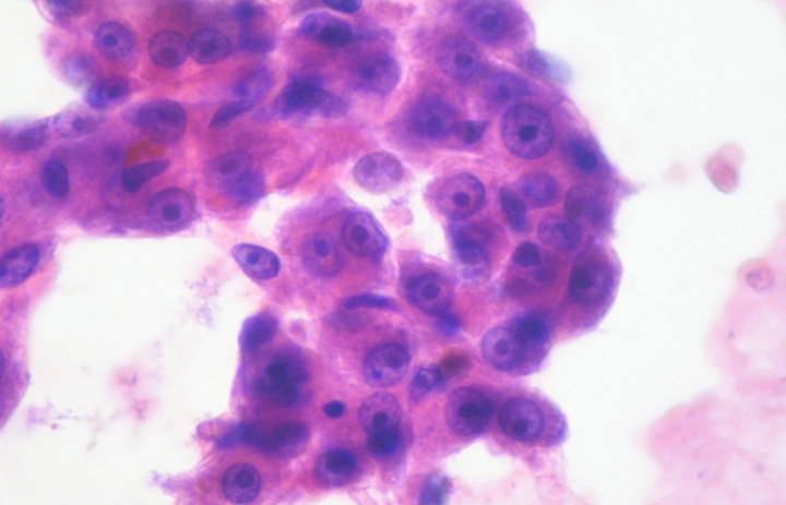 Обнаружен белок, подавляющий опухоли нескольких типов рака